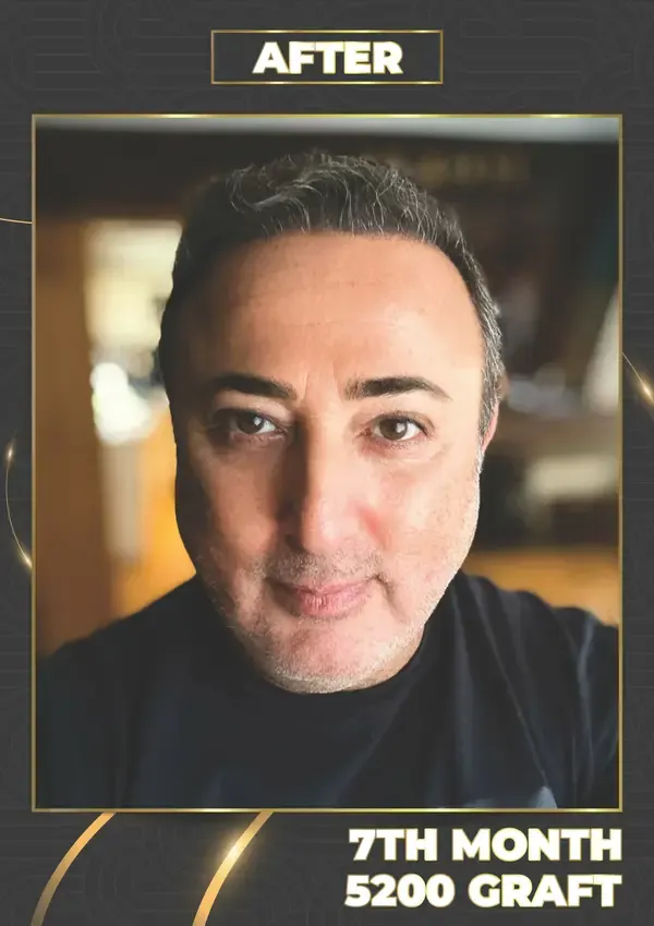 After: 5,200 grafts, 7 months after