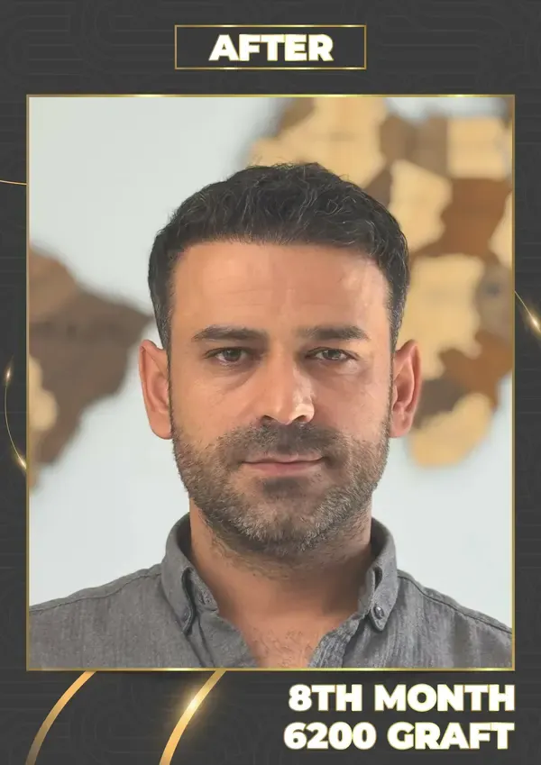 After: 6,200 grafts, 8 months after