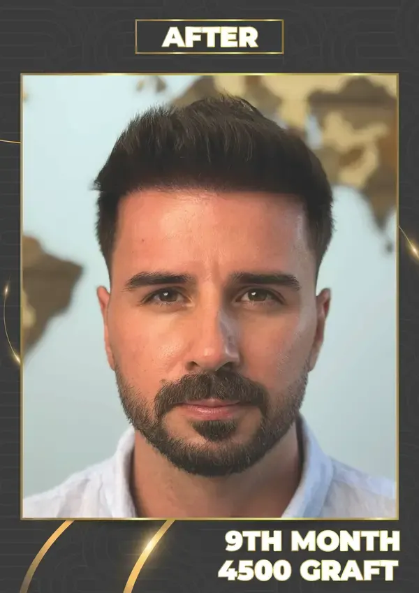After: 4,500 grafts, 9 months after