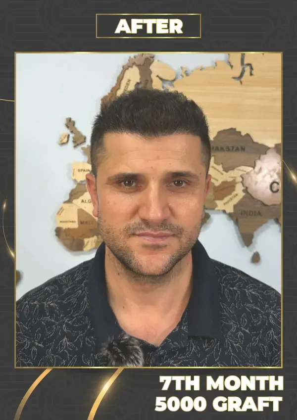 After: 5,000 grafts, 7 months after