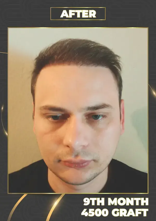 After: 4,500 grafts, 9 months after