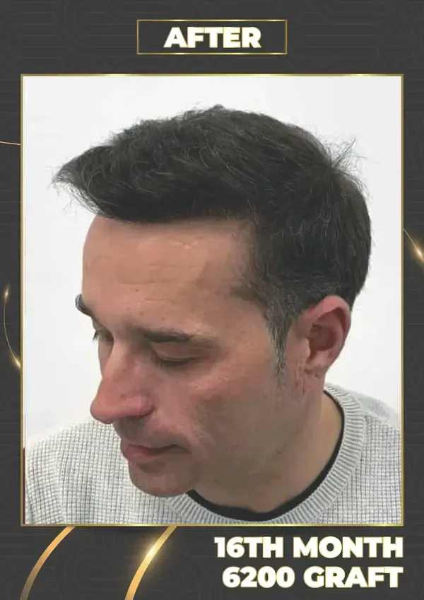 After: 6,200 grafts, 16 months after
