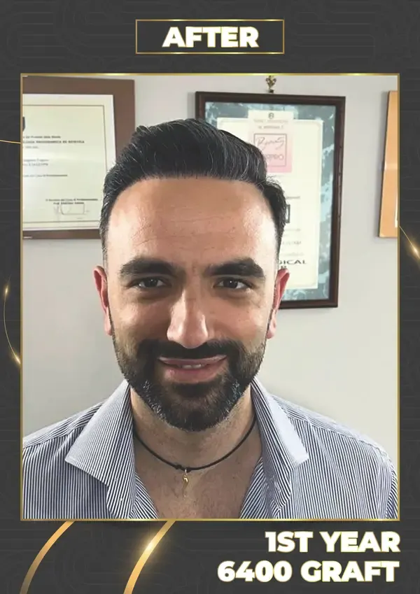 After: 6,400 grafts, 12 months after