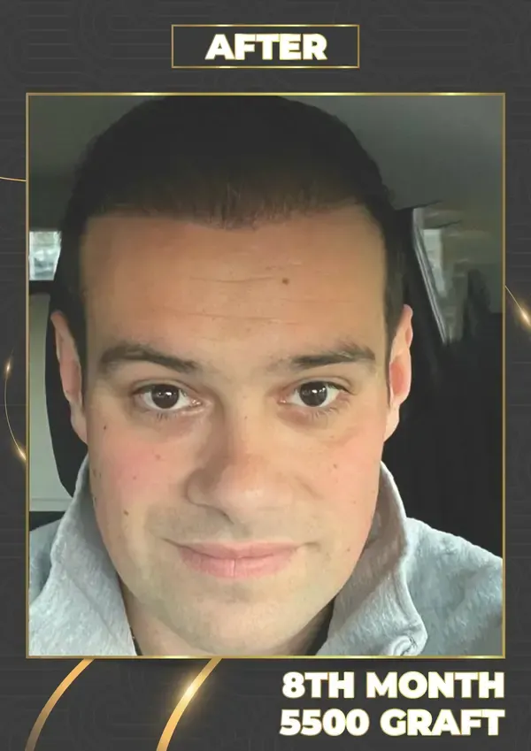After: 5,500 grafts, 8 months after