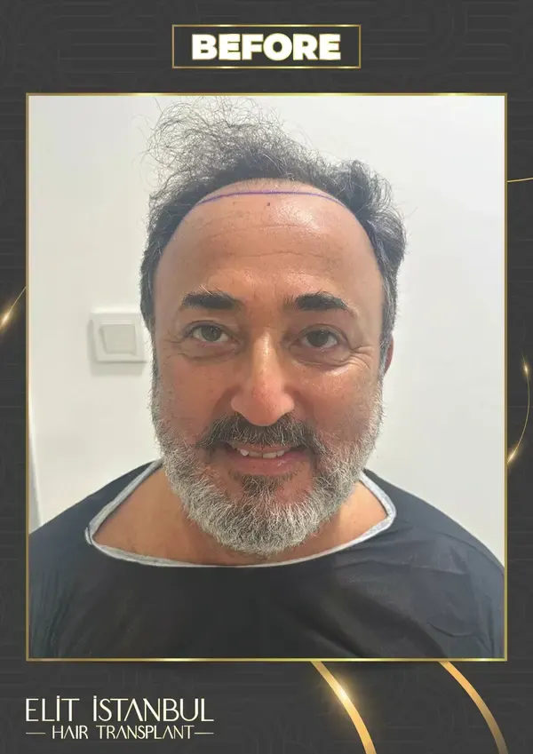 Before: 5,200 grafts, 7 months after