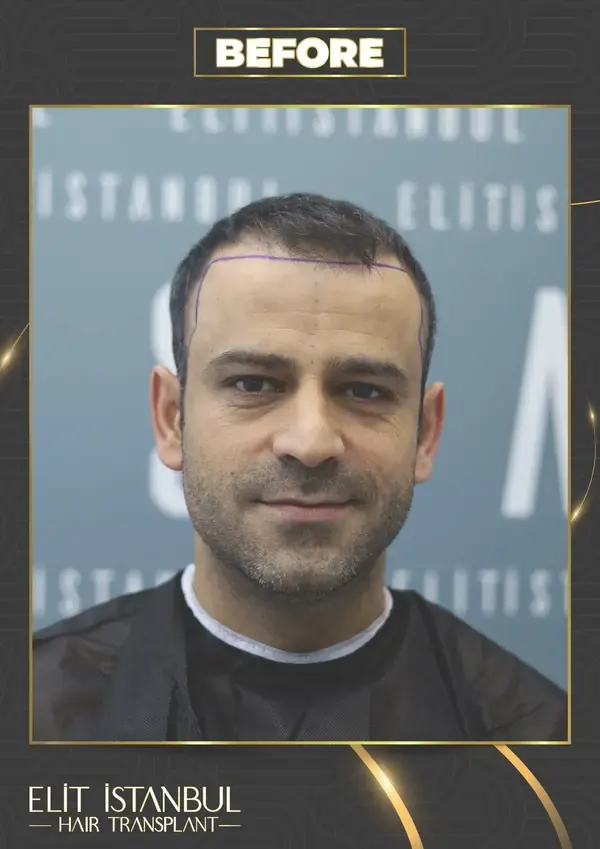 Before: 6,200 grafts, 8 months after
