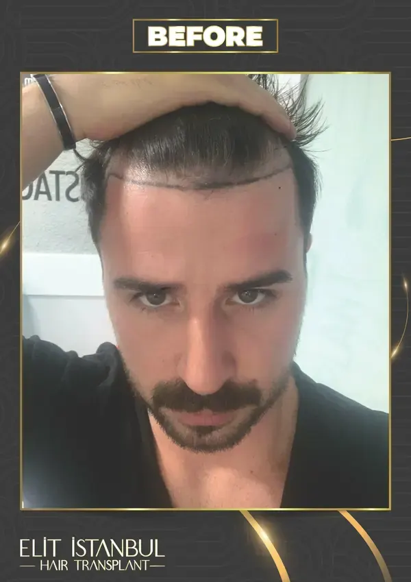 Before: 4,500 grafts, 9 months after