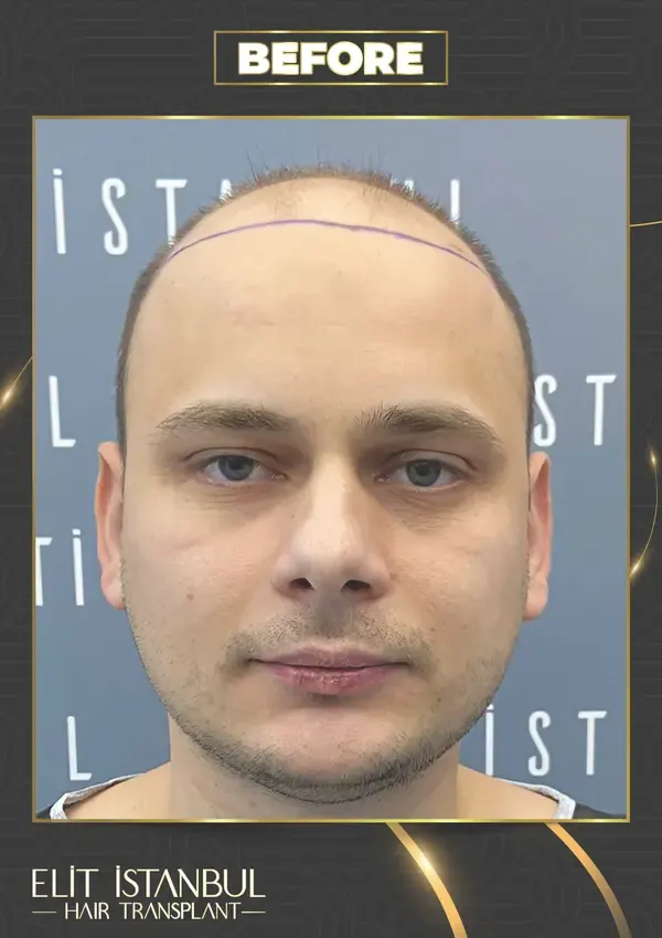 Before: 4,500 grafts, 9 months after