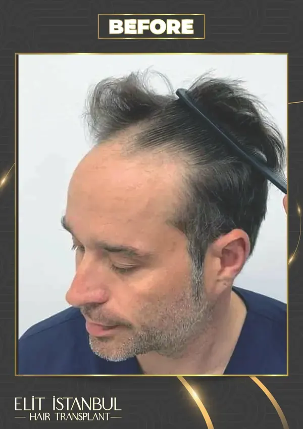 Before: 6,200 grafts, 16 months after