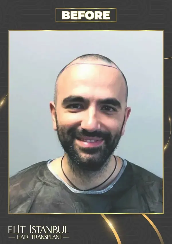 Before: 6,400 grafts, 12 months after
