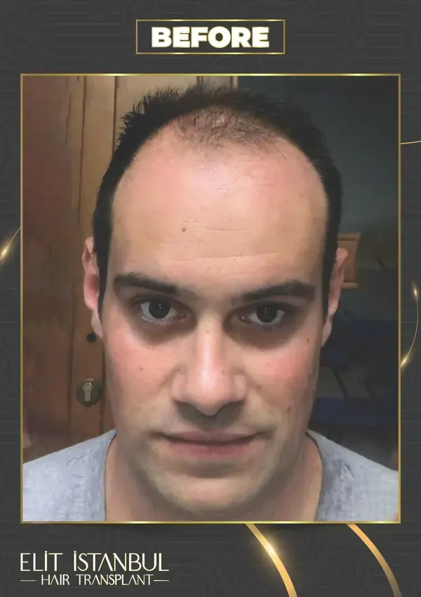 Before: 5,500 grafts, 8 months after